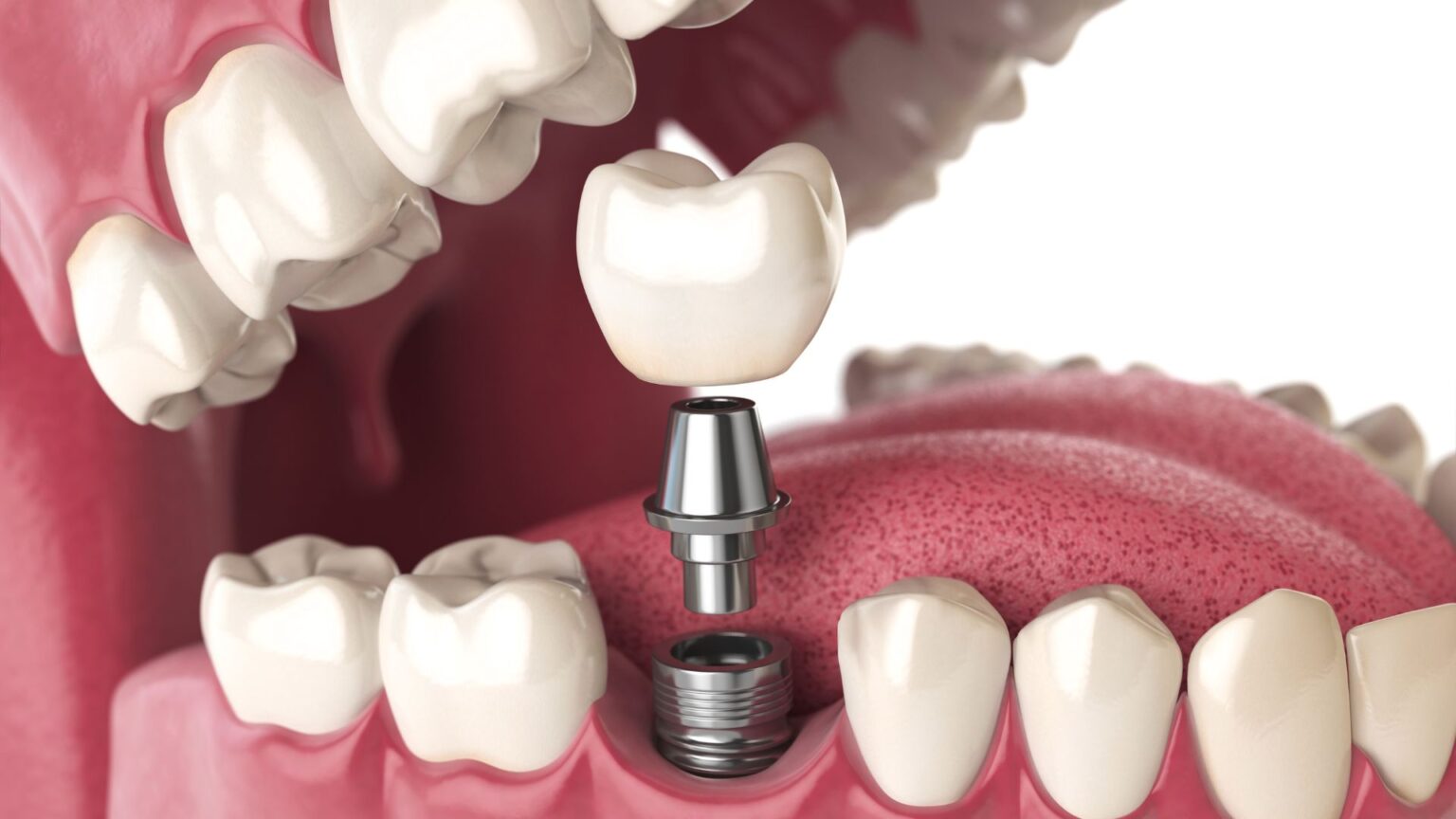 Dental Implants 1 dental implants georgetown